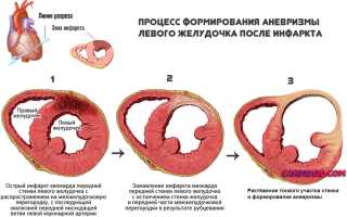 Аневризма митрального клапана