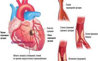 Шунтирование сердца после инфаркта