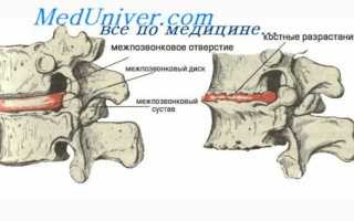 Почему после инфаркта болит голова