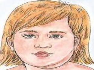 Болезнь свинка у детей: как проявляется и какие ее последствия