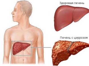 Как распознать первые признаки цирроза печени