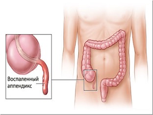 Какие симптомы при аппендиците