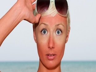 Какие существуют средства от солнечных ожогов лица