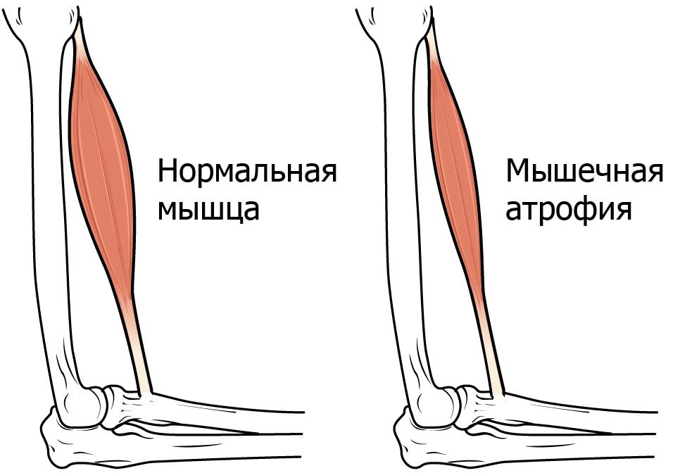 атрофия