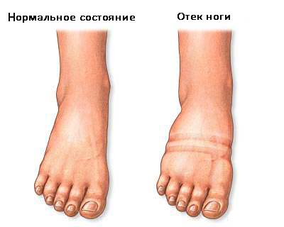 отеки ног